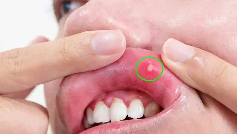 Kanserin Uyarı İşaretleri: Ağrıyı Görmezden Geldi, Dilini Kaybetti