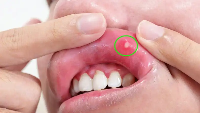 Vücudunuzun Uyardığı 5 Belirgin B Vitamini Eksikliği Belirtisi